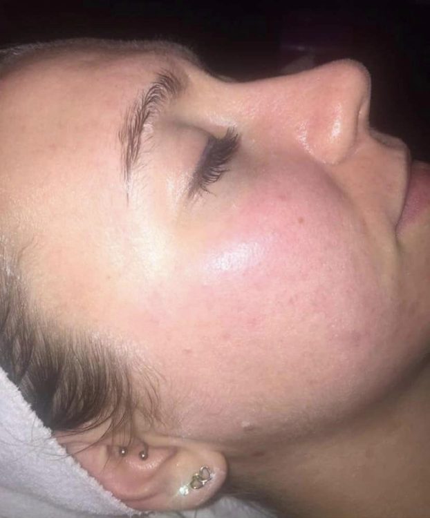 before and after microdermabrasion the blissful beauty company