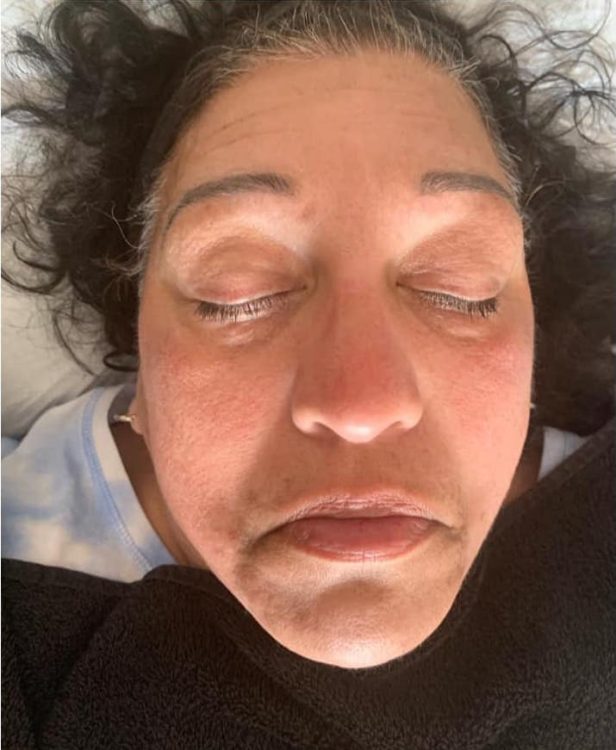 before and after microdermabrasion the blissful beauty company