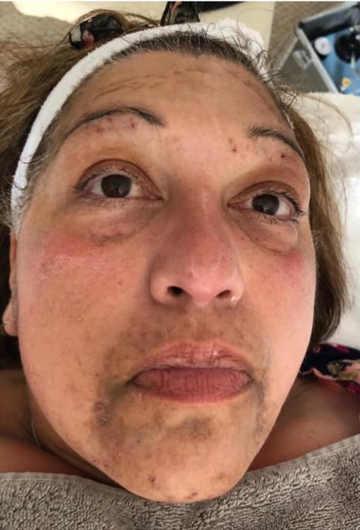 before and after microdermabrasion the blissful beauty company
