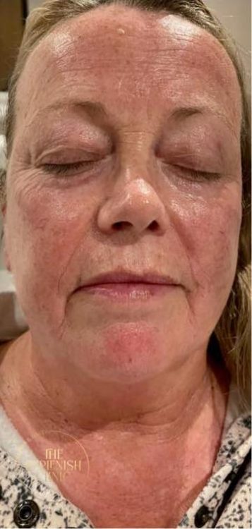 before and after collagen lift the replenish clinic