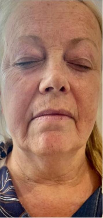 before and after collagen lift the replenish clinic
