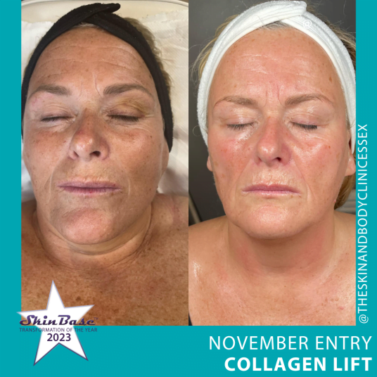 November Collagen Lift Entries THESKINANDBODYCLINICESSEX November Collagen Lift Entries THESKINANDBODYCLINICESSEX