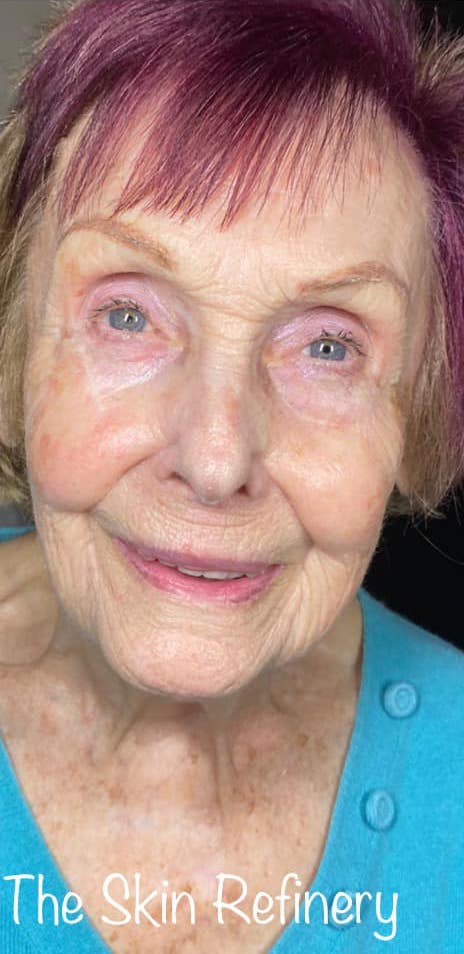 before and after microdermabrasion the skin refinery