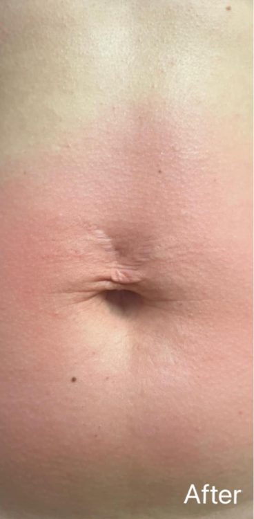 before and after collagen lift true essence beauty