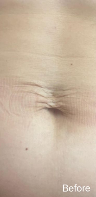before and after collagen lift true essence beauty