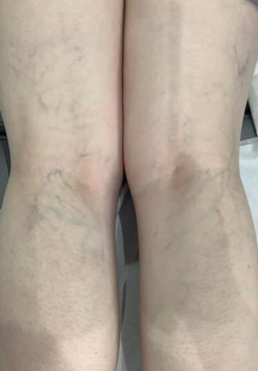 before and after ipl for thread veins advanced beauty and aesthetics