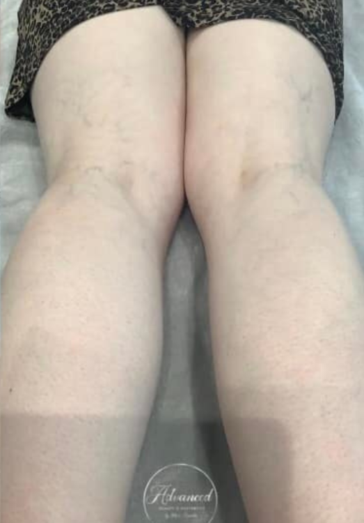 before and after ipl for thread veins advanced beauty and aesthetics