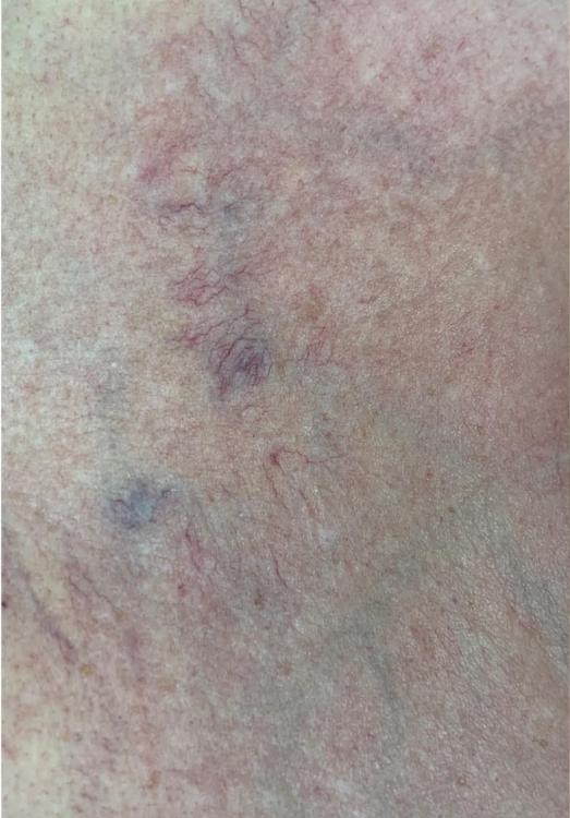 before and after ipl for thread veins beau medispa