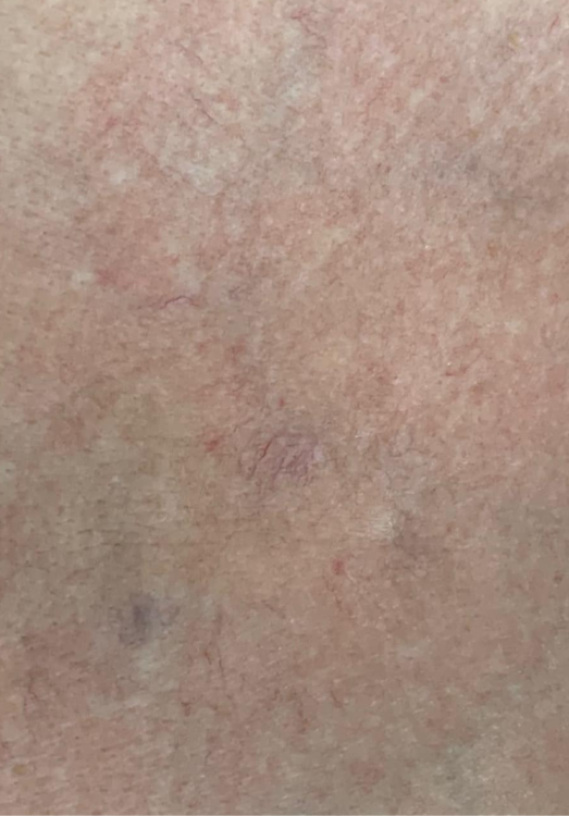 before and after ipl for thread veins beau medispa
