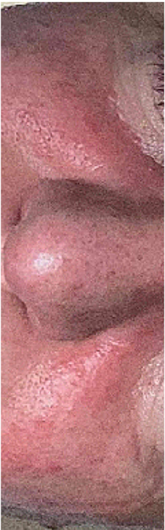 before and after IPL for rosacea devoe skincare 1