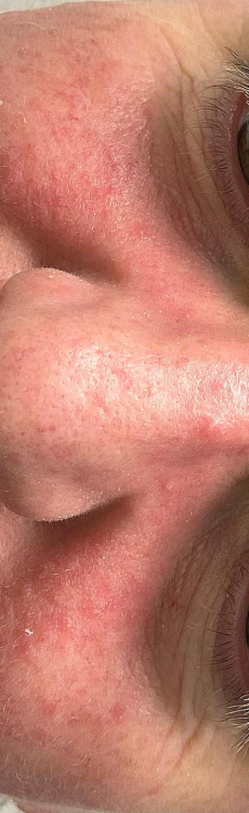 before and after IPL for rosacea devoe skincare 1