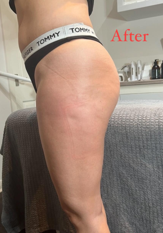 before and after collagen lift for cellulite Anna's beauty