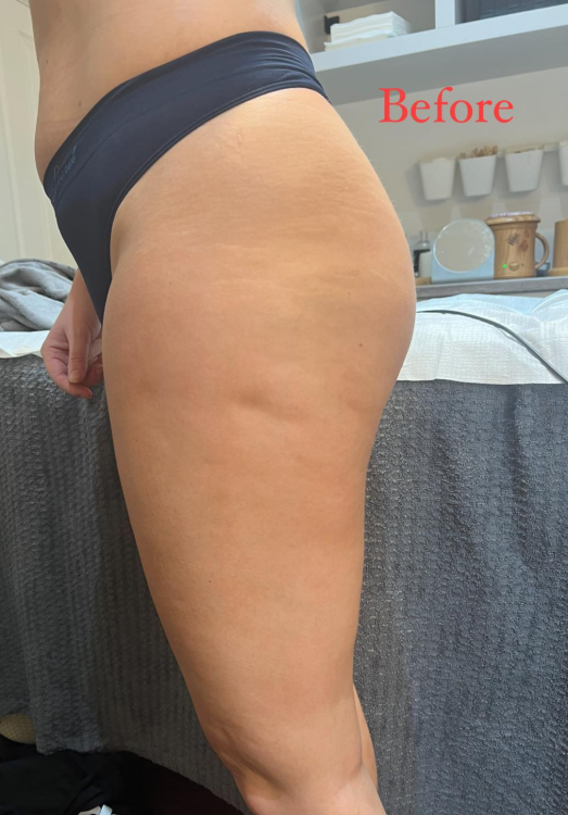 before and after collagen lift for cellulite Anna's beauty
