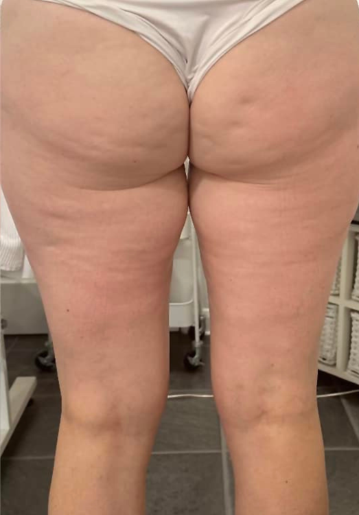 before and after collagen lift for cellulite Katherine Monique Beauty