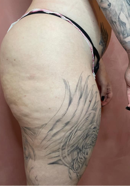 before and after collagen lift for cellulite current beauty