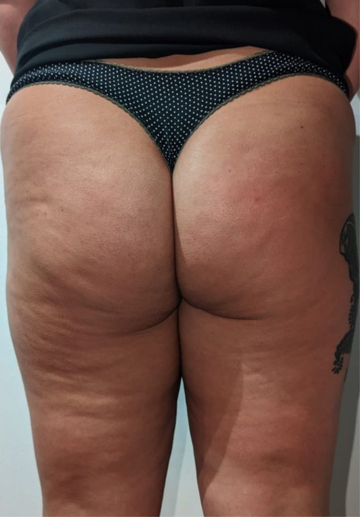 before and after collagen lift for cellulite modern alchemy beauty