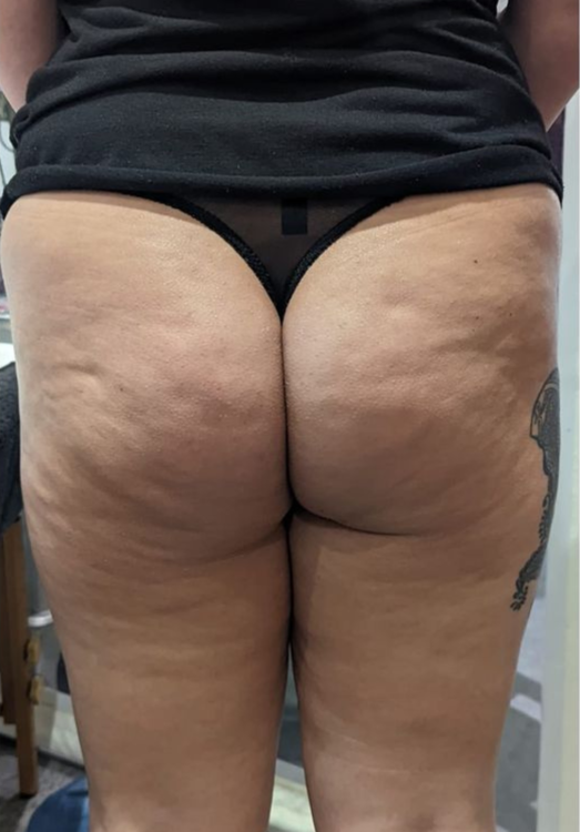 before and after collagen lift for cellulite modern alchemy beauty