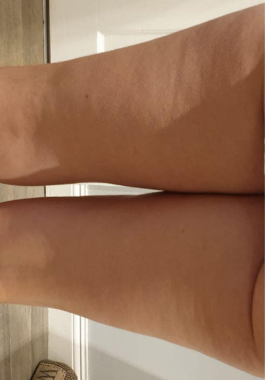 before and after collagen lift for cellulite top of the house beauty