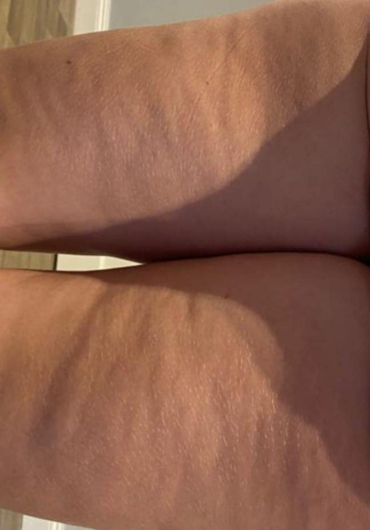 before and after collagen lift for cellulite top of the house beauty