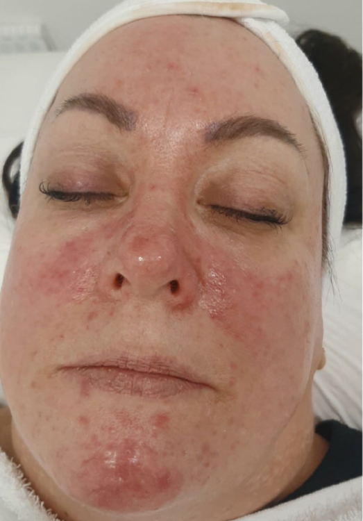 before and after ipl for rosacea skin tip