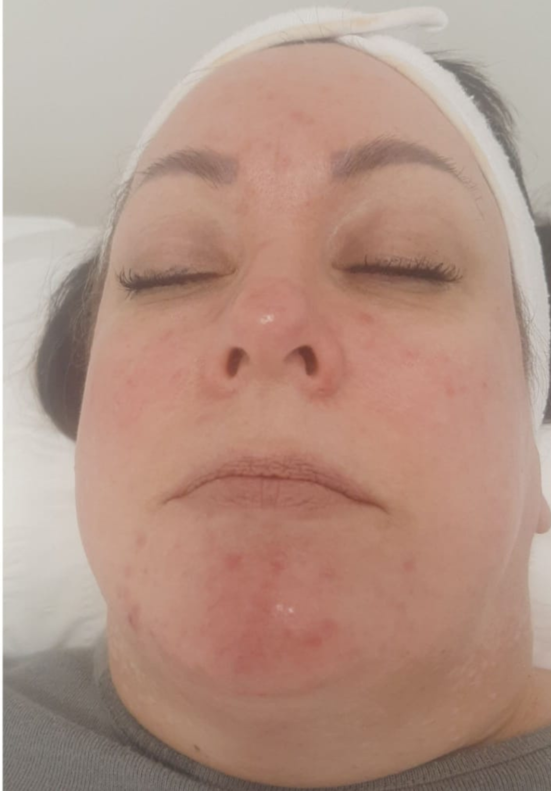 before and after ipl for rosacea skin tip