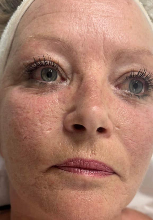 before and after microdermabrasion for rosacea katherine monique beauty