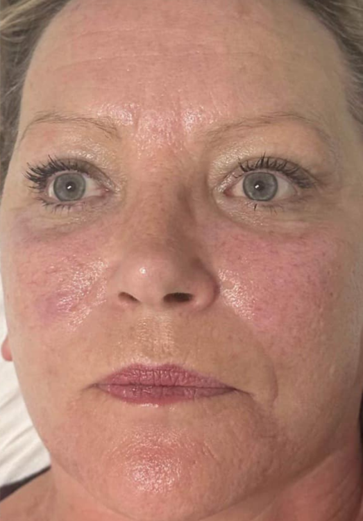 before and after microdermabrasion for rosacea katherine monique beauty