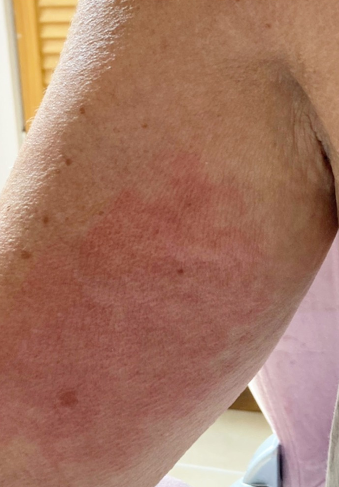 before and after collagen lift bijou beauty room