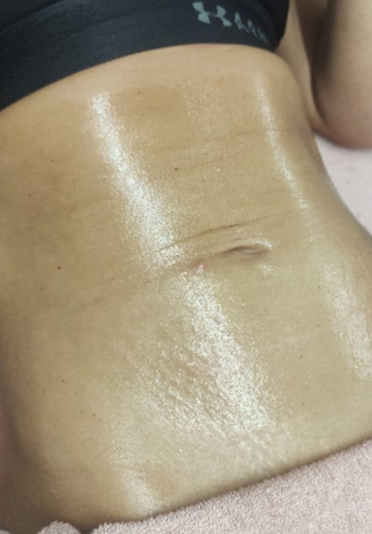 before and after collagen lift Carla Amanda beauty