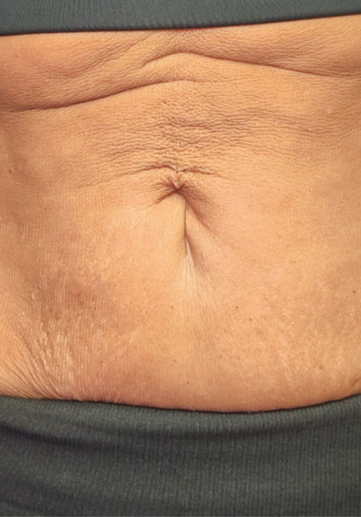 before and after collagen lift Carla Amanda beauty