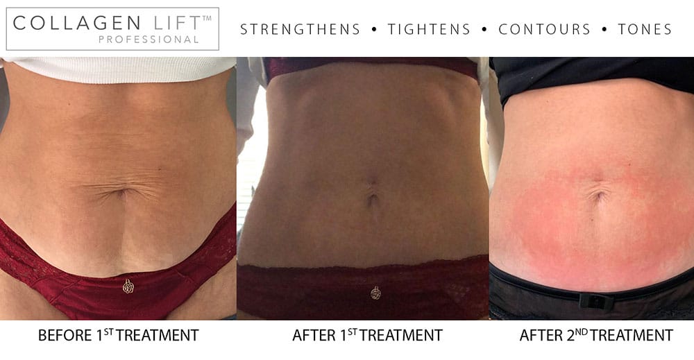 Collagen Lift results – Be warned, you’re going to want this treatment! Collagen Lift Transformation