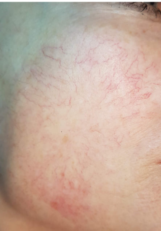before and after ipl for thread veins hey beautiful