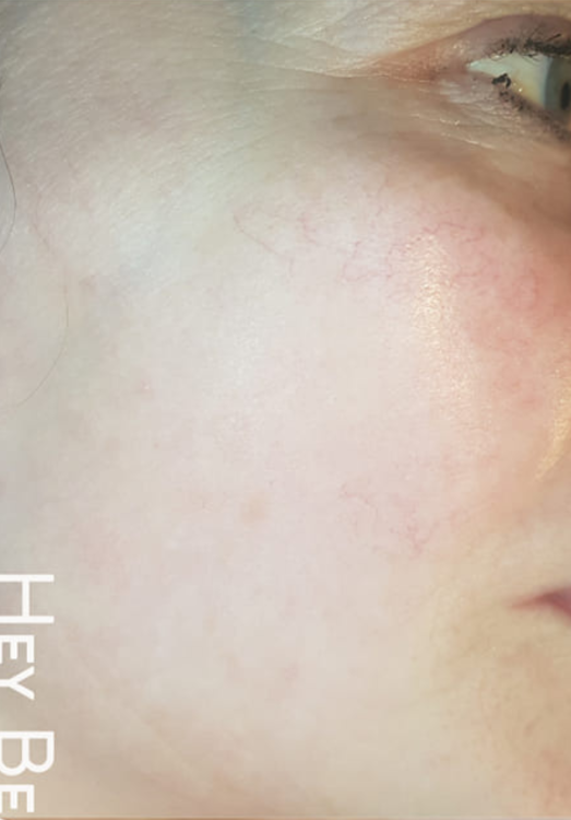 before and after ipl for thread veins hey beautiful