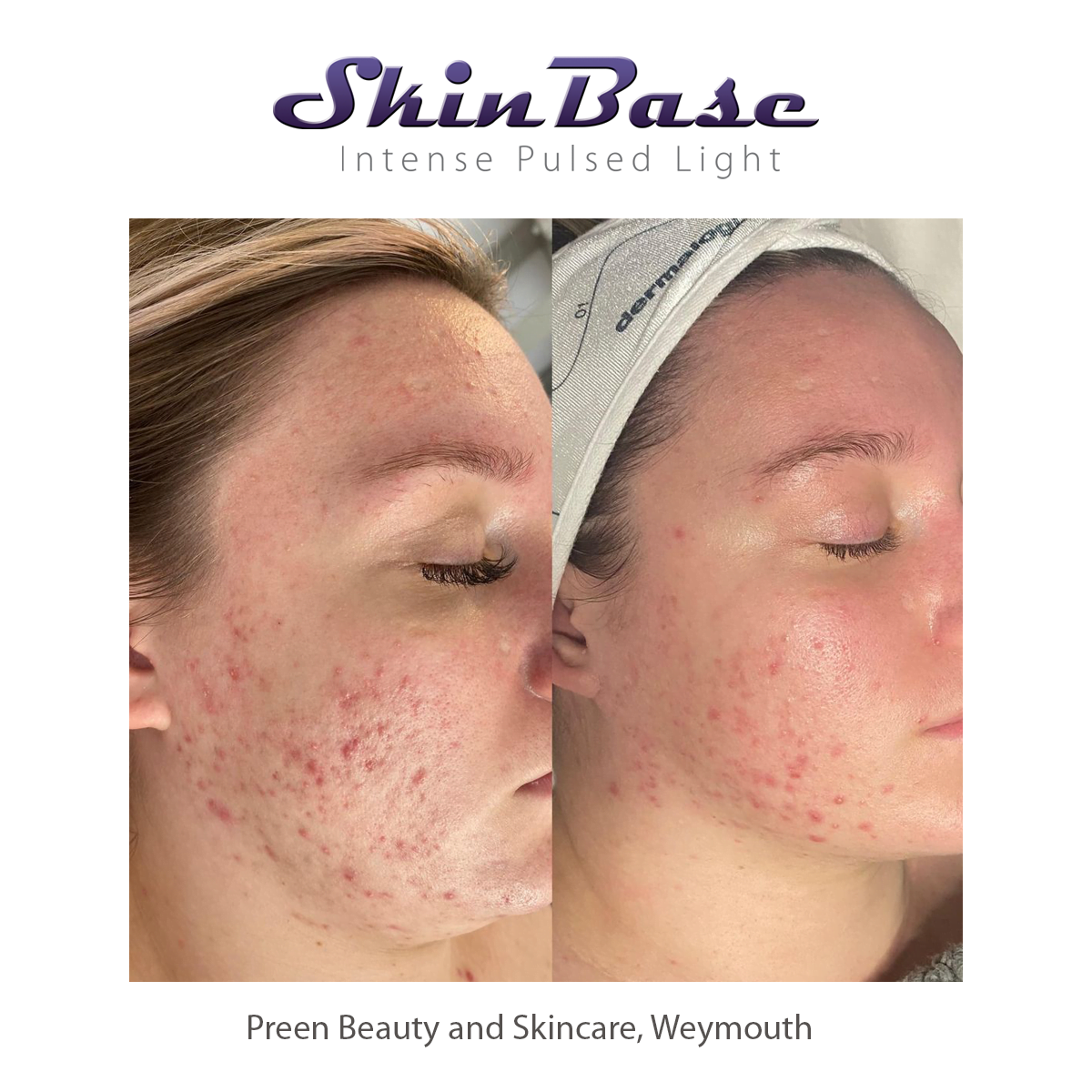ipl acne