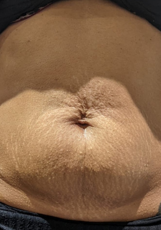 before and after collagen lift for stretch marks modern alchemy beauty
