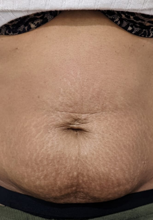 before and after collagen lift for stretch marks modern alchemy beauty