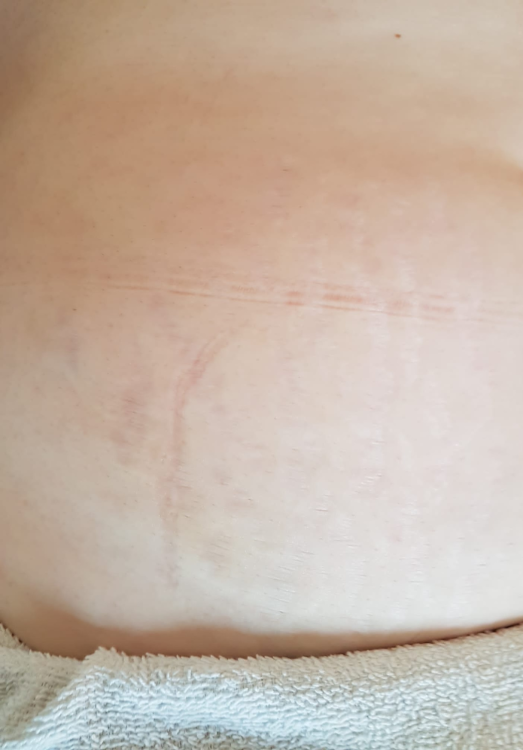 before and after collagen lift for stretch marks moss bank clinic