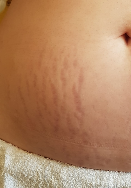 before and after collagen lift for stretch marks moss bank clinic