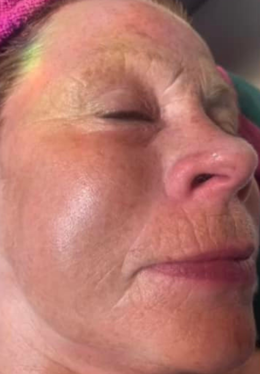 before and after ipl for pigmentation rosa nova