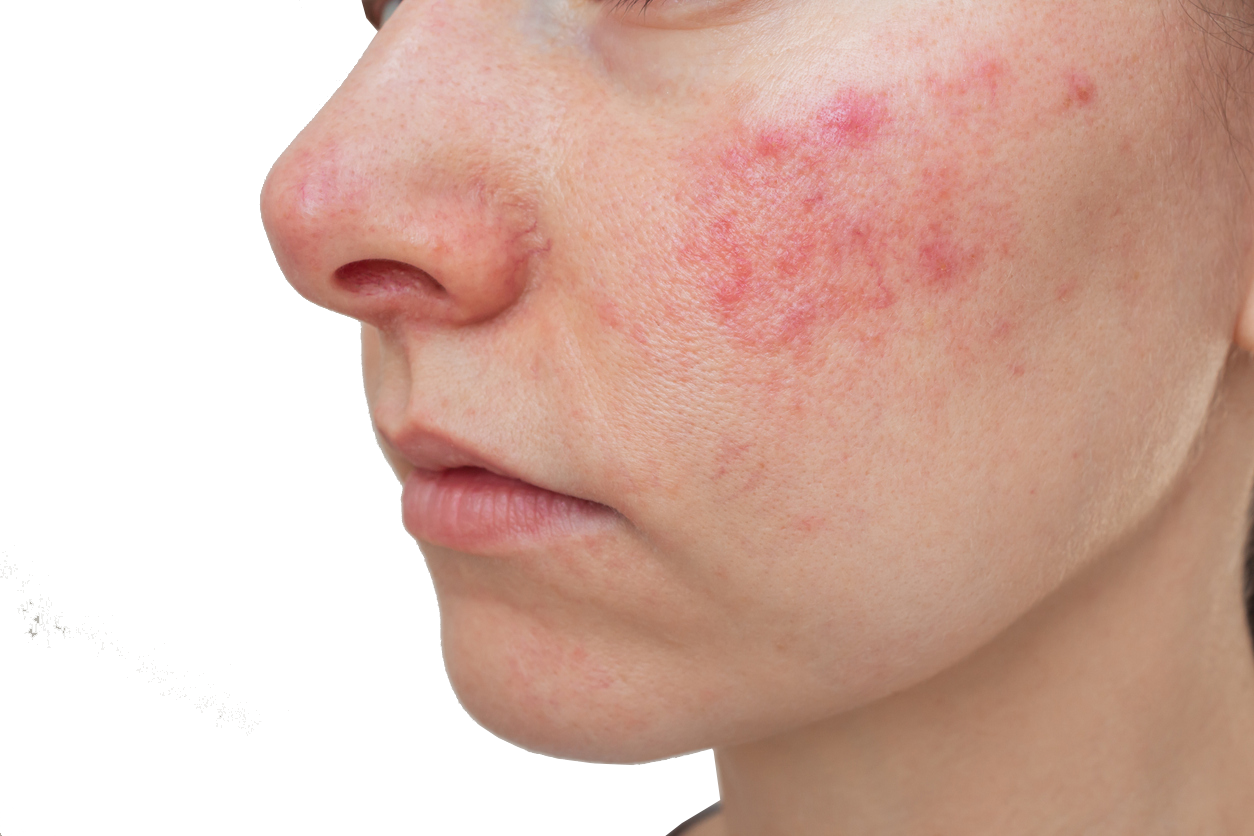 rosacea