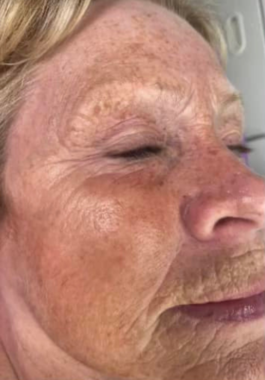 before and after ipl for pigmentation rosa nova