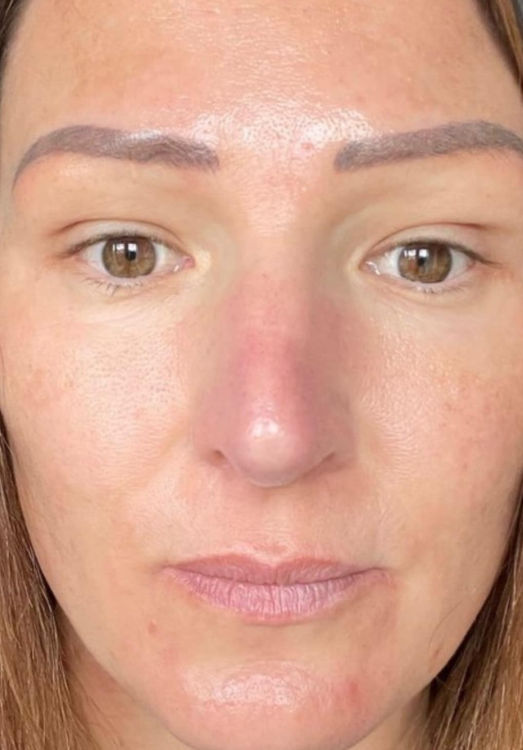 before and after IPL for pigmentation the jay's nest