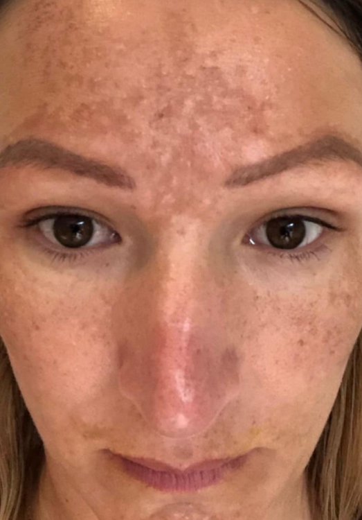 before and after IPL for pigmentation the jay's nest