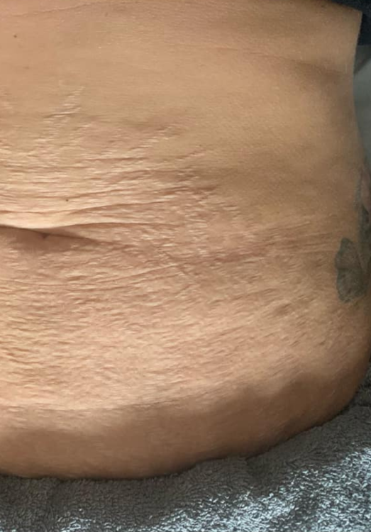 before and after microdermabrasion for stretch marks the blissful beauty company