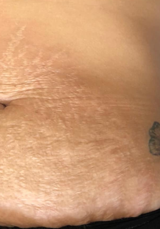before and after microdermabrasion for stretch marks the blissful beauty company