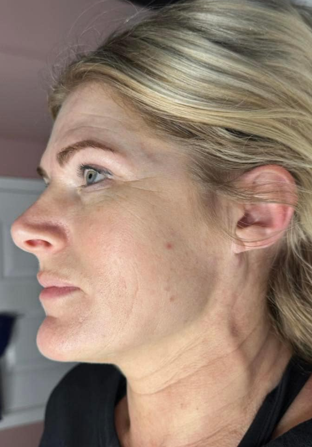 before and after collagen lift the boutik