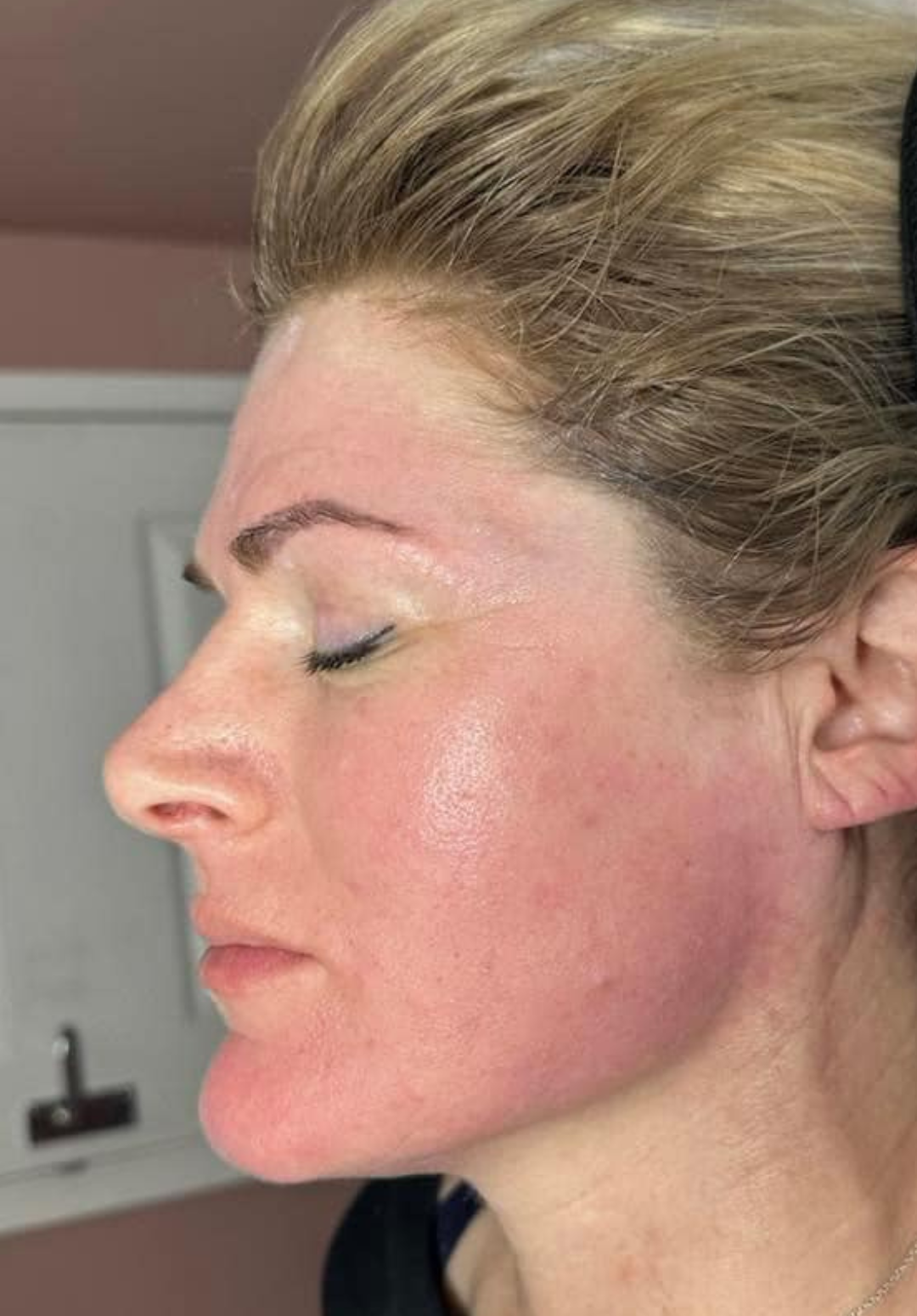 before and after collagen lift the boutik