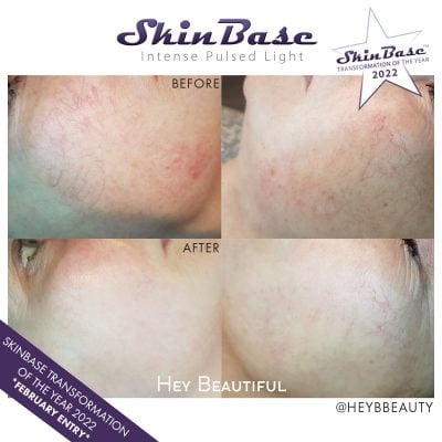 Hey beauty IPL treatment