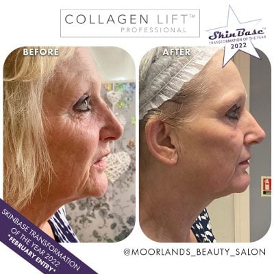 Moorlands Collagen Lift