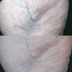 Vascular lesion treatment